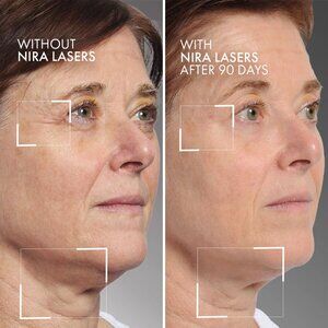 NIRA Pro Skincare Anti-Aging Laser